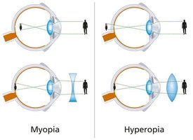 Optic nerve damage in glaucoma