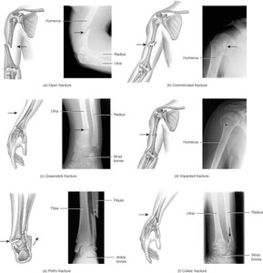 Common types of bone fractures