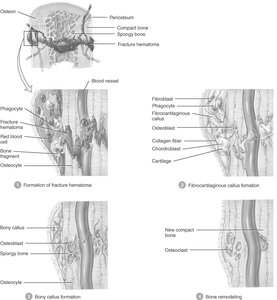 Stages of bone fracture repair