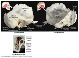 Lateral and medial views of temporal bone