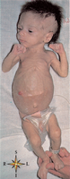 Clinical presentation of cystic fibrosis