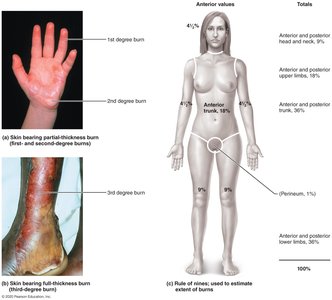 Diagram and photographs of burn types and rule of nines