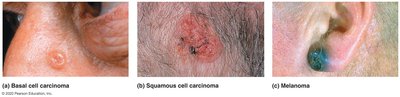 Photographs of basal cell carcinoma, squamous cell carcinoma, and melanoma