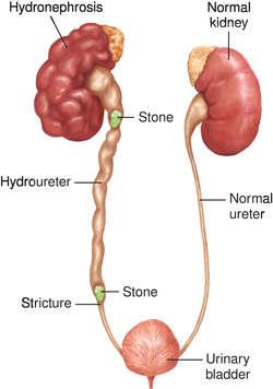 Diagram showing hydronephrosis and normal kidney for comparison