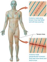 Tension lines for surgical incisions