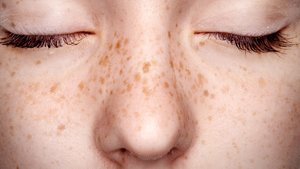 Freckles