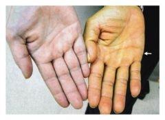 Carotene pigmentation