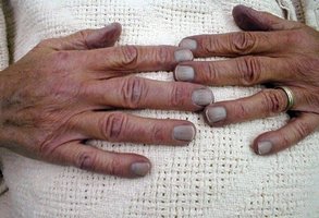 Cyanosis