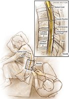 Patient position and needle placement for lumbar puncture