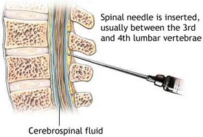 Needle insertion for lumbar puncture between L3 and L4