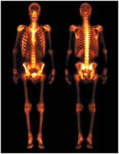 Radiotracer scan showing skeletal system