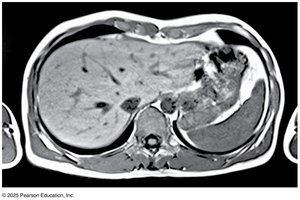 MRI of abdominopelvic cavity