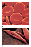 Normal and sickle-shaped red blood cells