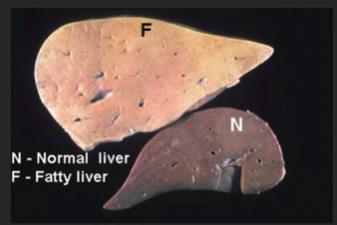 Fatty liver due to excess fructose