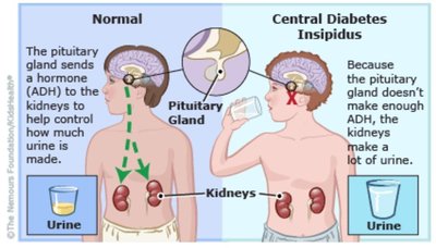 Diagram explaining diabetes insipidus and ADH function