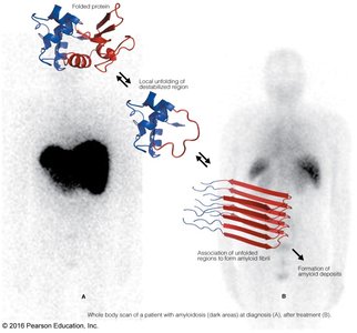 Amyloid formation and whole body scan of amyloidosis