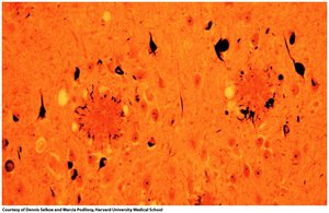 Amyloid plaques in Alzheimer's disease