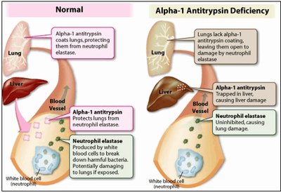 Normal vs AAT deficiency diagram