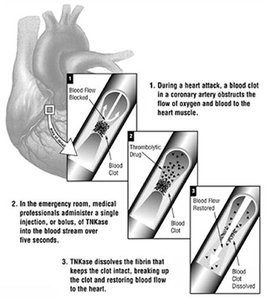 TNKase mechanism in heart attack