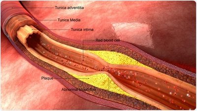 Atherosclerotic plaque formation in a blood vessel