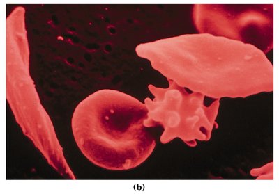 Erythrocytes in sickle cell anemia