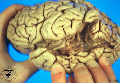Brain with Wernicke's aphasia