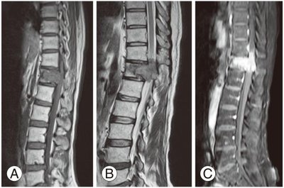 MRI images of lumbar spine showing bone metastasis