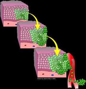 Cancer cell invasion and metastasis