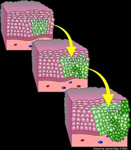 Tumor formation in tissue