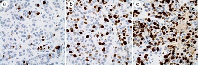 Ki-67 expression in biopsy samples