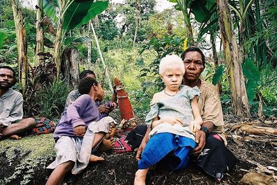 Albinism in Papua, New Guinea