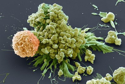 Scanning electron micrograph of immune cell attacking a cancer cell, illustrating cancer immunotherapy