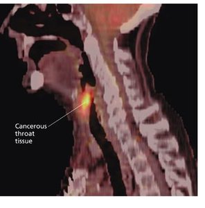 PET scan showing cancerous tissue