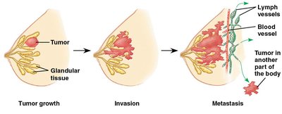 Tumor growth, invasion, and metastasis
