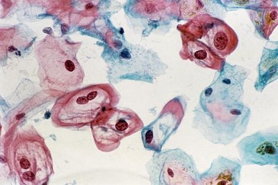 Cytology smear showing abnormal cells