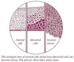 Progression from normal to abnormal to invasive cervical cancer