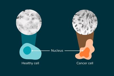 Healthy cell vs cancer cell nucleus