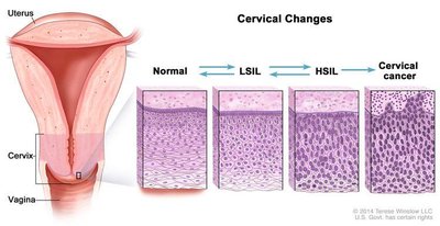 Cervical changes from normal to cancer