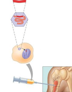 Gene therapy using a retroviral vector