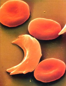 Pedigree for sickle cell disease