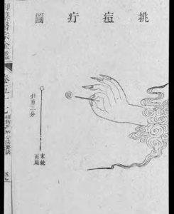 Historical medical text on inoculation