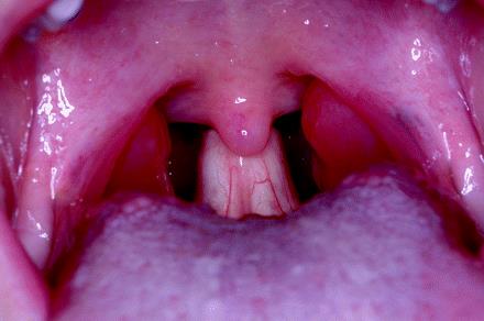 High-rising epiglottis behind the uvula