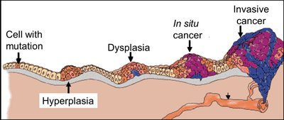 Stages of cancer progression