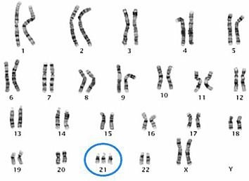 Karyotype showing Down syndrome (trisomy 21)