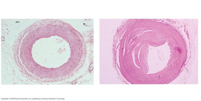 Normal and clogged artery cross-sections