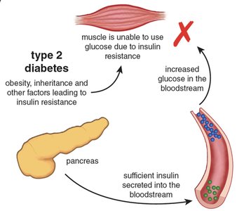 Type 2 diabetes and insulin resistance diagram
