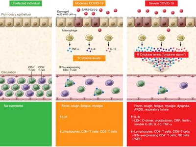 Diagram comparing immune response in uninfected, moderate, and severe Covid-19 cases
