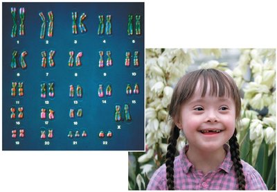 Karyotype and individual with Down Syndrome