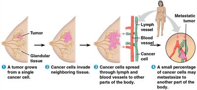 Breast cancer metastasis