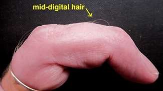 Mid-digital hair trait